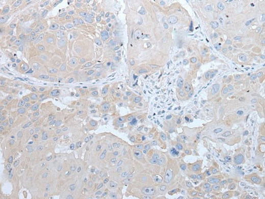 Immunohistochemistry of paraffin-embedded Human esophagus cancer tissue using IFNB1 Polyclonal Antibody at dilution of 1:45(×200)
