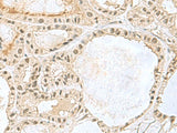Immunohistochemistry of paraffin-embedded Human thyroid cancer tissue using KDM3B Polyclonal Antibody at dilution of 1:45(×200)