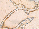 Immunohistochemistry of paraffin-embedded Human thyroid cancer tissue using IP6K3 Polyclonal Antibody at dilution of 1:50(×200)