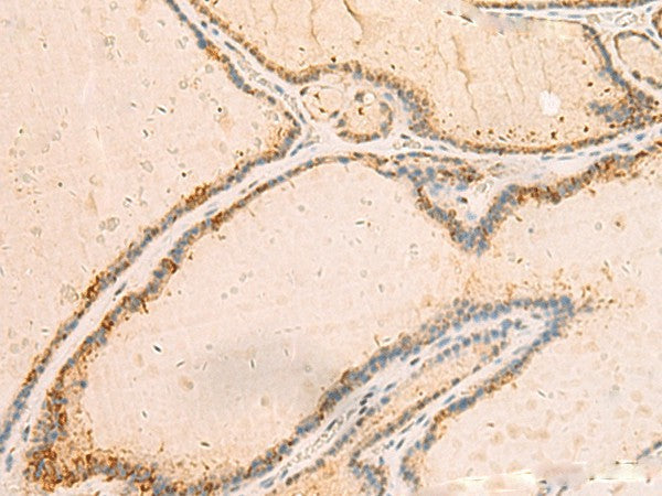 Immunohistochemistry of paraffin-embedded Human thyroid cancer tissue using IP6K3 Polyclonal Antibody at dilution of 1:50(×200)
