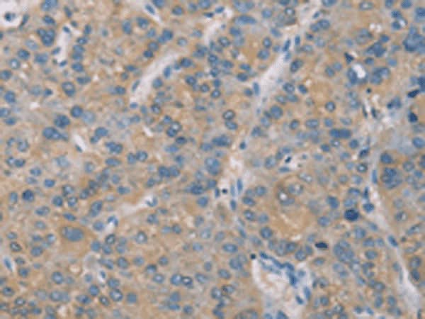Immunohistochemistry of paraffin-embedded Human liver cancer tissue using ZBTB6 Polyclonal Antibody at dilution of 1:50(×200)