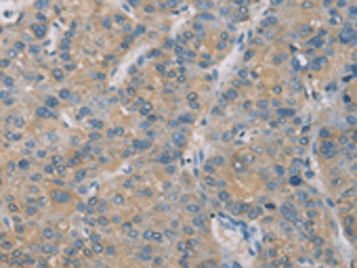 Immunohistochemistry of paraffin-embedded Human liver cancer tissue using ZBTB6 Polyclonal Antibody at dilution of 1:50(×200)