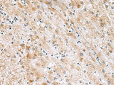 Immunohistochemistry of paraffin-embedded Human liver cancer tissue using GPC2 Polyclonal Antibody at dilution of 1:40(×200)