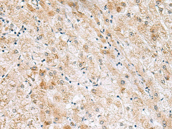 Immunohistochemistry of paraffin-embedded Human liver cancer tissue using GPC2 Polyclonal Antibody at dilution of 1:40(×200)