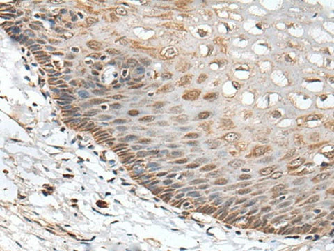 Immunohistochemistry of paraffin-embedded Human esophagus cancer tissue using CHRNA5 Polyclonal Antibody at dilution of 1:50(×200)