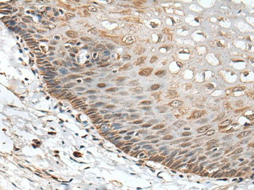 Immunohistochemistry of paraffin-embedded Human esophagus cancer tissue using CHRNA5 Polyclonal Antibody at dilution of 1:50(×200)