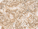 Immunohistochemistry of paraffin-embedded Human gastric cancer tissue using WEE1 Polyclonal Antibody at dilution of 1:35(×200)