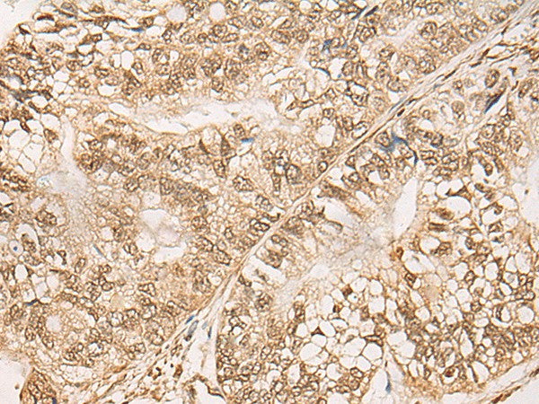 Immunohistochemistry of paraffin-embedded Human gastric cancer tissue using WEE1 Polyclonal Antibody at dilution of 1:35(×200)