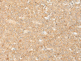 Immunohistochemistry of paraffin-embedded Human ovarian cancer tissue using LGALSL Polyclonal Antibody at dilution of 1:70(×200)