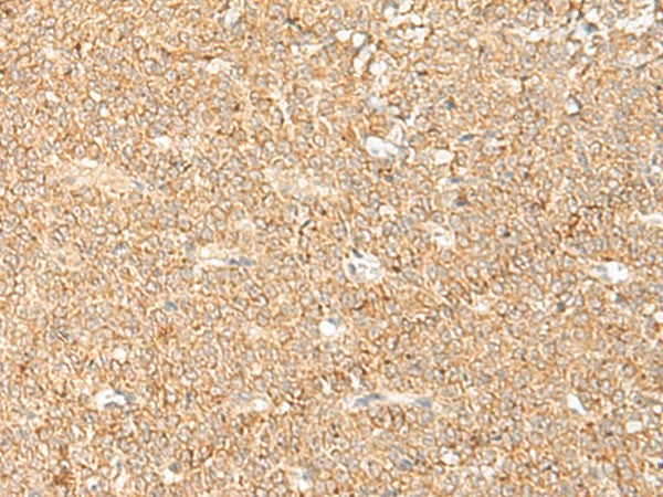 Immunohistochemistry of paraffin-embedded Human ovarian cancer tissue using LGALSL Polyclonal Antibody at dilution of 1:70(×200)