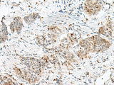 Immunohistochemistry of paraffin-embedded Human esophagus cancer tissue using PLCL2 Polyclonal Antibody at dilution of 1:50(×200)
