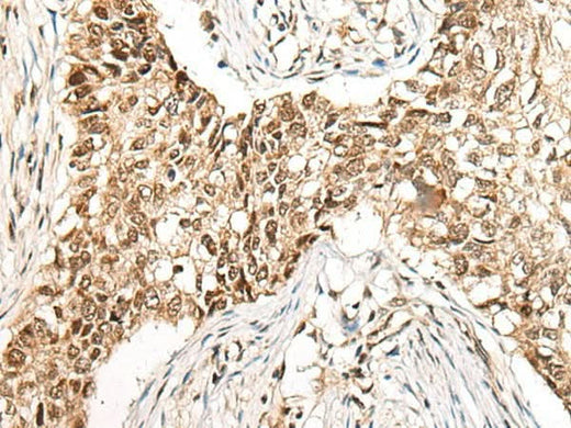 Immunohistochemistry of paraffin-embedded Human lung cancer tissue using CCDC181 Polyclonal Antibody at dilution of 1:50(×200)