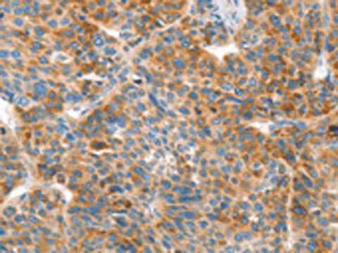 Immunohistochemistry of paraffin-embedded Human liver cancer tissue using VTN Polyclonal Antibody at dilution of 1:100(×200)