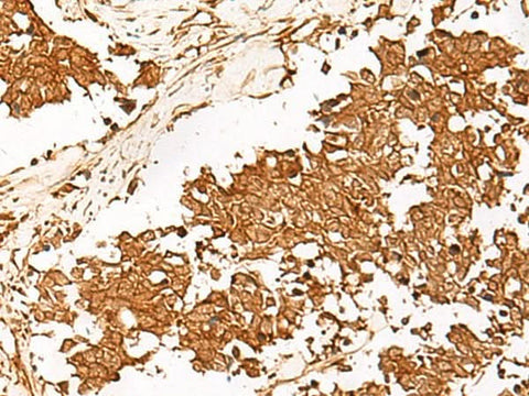Immunohistochemistry of paraffin-embedded Human lung cancer tissue using HUS1 Polyclonal Antibody at dilution of 1:65(×200)