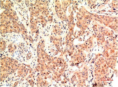 Immunohistochemistry of paraffin-embedded Human breast carcinoma tissue using ERK 1 Monoclonal Antibody at dilution of 1:200.