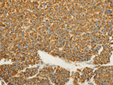 Immunohistochemistry of paraffin-embedded Human liver cancer tissue using VDAC2 Polyclonal Antibody at dilution of 1:25(×200)