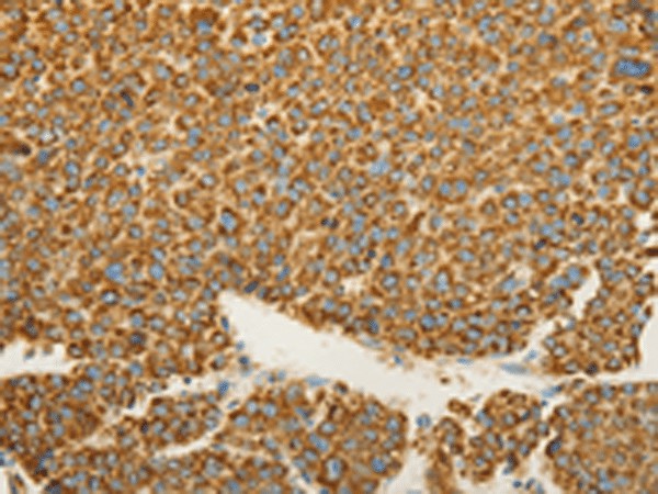 Immunohistochemistry of paraffin-embedded Human liver cancer tissue using VDAC2 Polyclonal Antibody at dilution of 1:25(×200)
