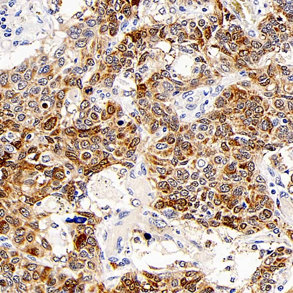 Immunohistochemistry analysis of paraffin-embedded human lung cancer using CD107b Polyclonal Antibody at dilution of 1:300.