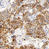 Immunohistochemistry analysis of paraffin-embedded human lung cancer using CD107b Polyclonal Antibody at dilution of 1:300.