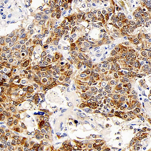 Immunohistochemistry analysis of paraffin-embedded human lung cancer using CD107b Polyclonal Antibody at dilution of 1:300.
