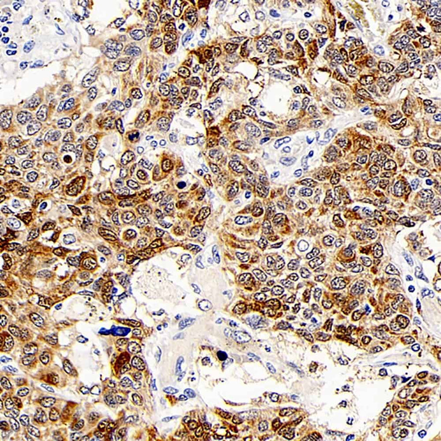 Immunohistochemistry analysis of paraffin-embedded human lung cancer using CD107b Polyclonal Antibody at dilution of 1:300.