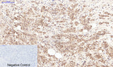 Immunohistochemistry of paraffin-embedded Human breast cancer tissue using LTF Monoclonal Antibody at dilution of 1:200.