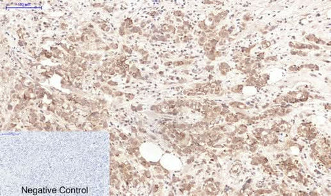 Immunohistochemistry of paraffin-embedded Human breast cancer tissue using LTF Monoclonal Antibody at dilution of 1:200.