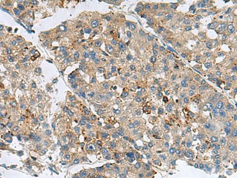 Immunohistochemistry of paraffin-embedded Human liver cancer tissue using MED31 Polyclonal Antibody at dilution of 1:100(×200)