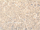 Immunohistochemistry of paraffin-embedded Human ovarian cancer tissue using NARF Polyclonal Antibody at dilution of 1:45(×200)