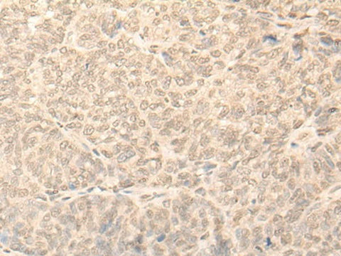 Immunohistochemistry of paraffin-embedded Human ovarian cancer tissue using NARF Polyclonal Antibody at dilution of 1:45(×200)