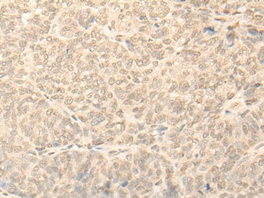 Immunohistochemistry of paraffin-embedded Human ovarian cancer tissue using NARF Polyclonal Antibody at dilution of 1:45(×200)