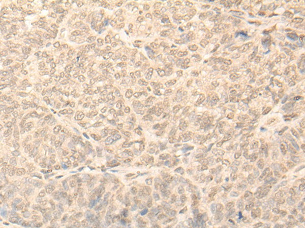 Immunohistochemistry of paraffin-embedded Human ovarian cancer tissue using NARF Polyclonal Antibody at dilution of 1:45(×200)
