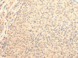 Immunohistochemistry of paraffin-embedded Human cervical cancer tissue using DAZ1 Polyclonal Antibody at dilution of 1:70(×200)