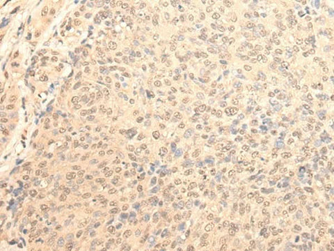 Immunohistochemistry of paraffin-embedded Human cervical cancer tissue using DAZ1 Polyclonal Antibody at dilution of 1:70(×200)