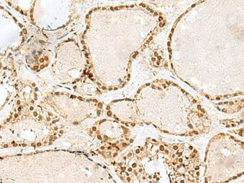 Immunohistochemistry of paraffin-embedded Human thyroid cancer tissue using GTF3C2 Polyclonal Antibody at dilution of 1:45(×200)