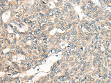 Immunohistochemistry of paraffin-embedded Human liver cancer tissue using LRP1B Polyclonal Antibody at dilution of 1:50(×200)