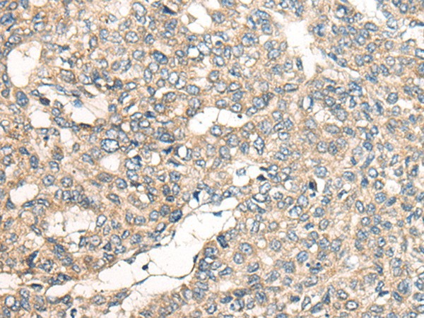 Immunohistochemistry of paraffin-embedded Human liver cancer tissue using LRP1B Polyclonal Antibody at dilution of 1:50(×200)
