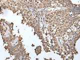 Immunohistochemistry of paraffin-embedded Human ovarian cancer tissue using METAP1D Polyclonal Antibody at dilution of 1:40(×200)