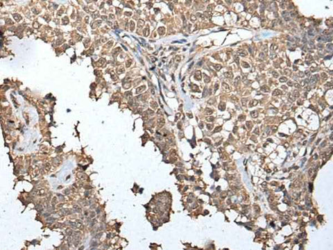 Immunohistochemistry of paraffin-embedded Human ovarian cancer tissue using METAP1D Polyclonal Antibody at dilution of 1:40(×200)