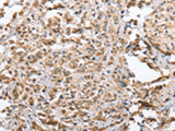 Immunohistochemistry of paraffin-embedded Human prost at e cancer tissue using ZFYVE16 Polyclonal Antibody at dilution of 1:60(×200)