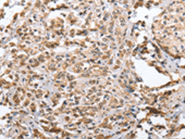 Immunohistochemistry of paraffin-embedded Human prost at e cancer tissue using ZFYVE16 Polyclonal Antibody at dilution of 1:60(×200)