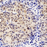 Immunohistochemistry analysis of paraffin-embedded mice tumor with hela using SOX-2 Polyclonal Antibody at dilution of 1:300.