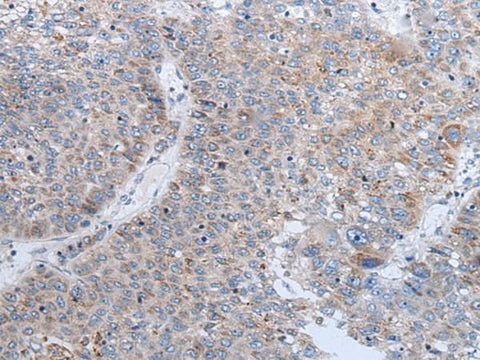 Immunohistochemistry of paraffin-embedded Human liver cancer tissue using ENPP2 Polyclonal Antibody at dilution of 1:50(×200)