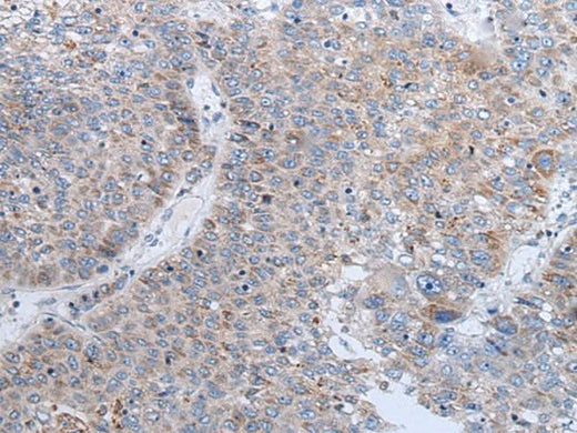 Immunohistochemistry of paraffin-embedded Human liver cancer tissue using ENPP2 Polyclonal Antibody at dilution of 1:50(×200)