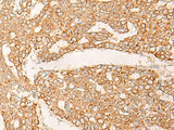 Immunohistochemistry of paraffin-embedded Human liver cancer tissue using KRT9 Polyclonal Antibody at dilution of 1:30(×200)