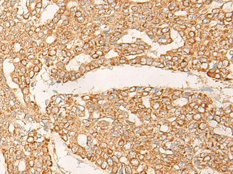 Immunohistochemistry of paraffin-embedded Human liver cancer tissue using KRT9 Polyclonal Antibody at dilution of 1:30(×200)