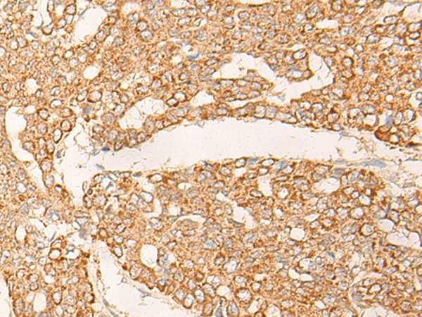 Immunohistochemistry of paraffin-embedded Human liver cancer tissue using KRT9 Polyclonal Antibody at dilution of 1:30(×200)
