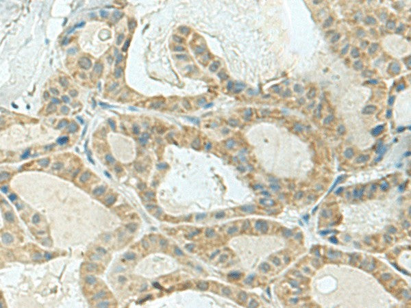 Immunohistochemistry of paraffin-embedded Human thyroid cancer tissue using KLC2 Polyclonal Antibody at dilution of 1:120(×200)
