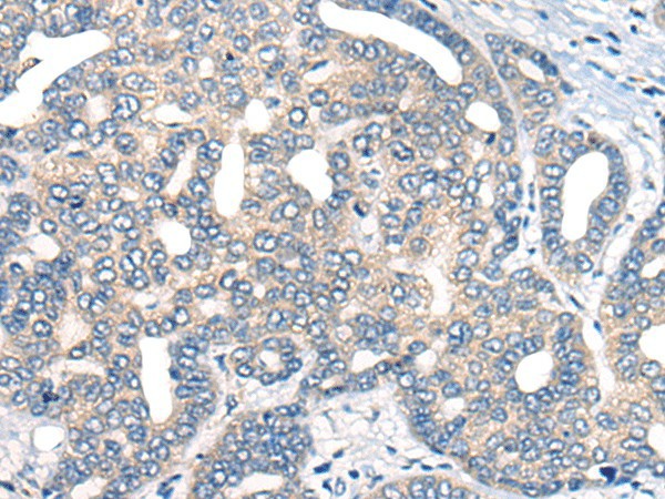Immunohistochemistry of paraffin-embedded Human liver cancer tissue using AURKA Polyclonal Antibody at dilution of 1:40(×200)