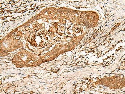 Immunohistochemistry of paraffin-embedded Human esophagus cancer tissue using HIRIP3 Polyclonal Antibody at dilution of 1:60(×200)